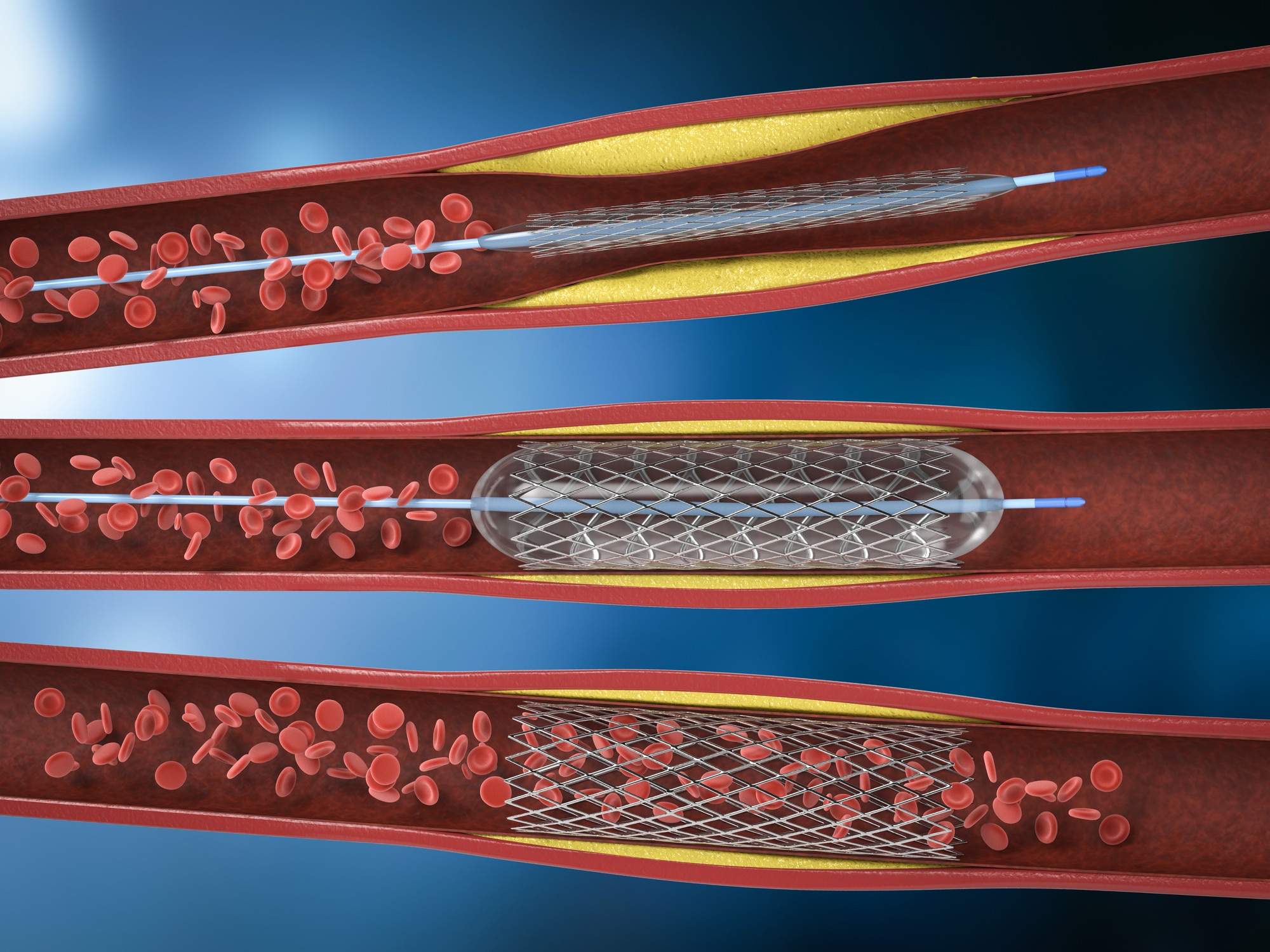 penumbra-catheter-class-action-lawsuit-catheter-injury-lawyer